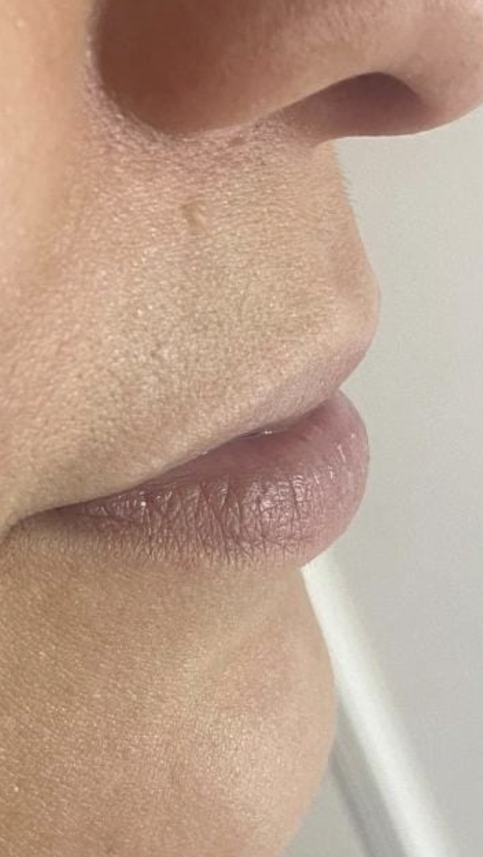 Antes - Preenchimento Labial