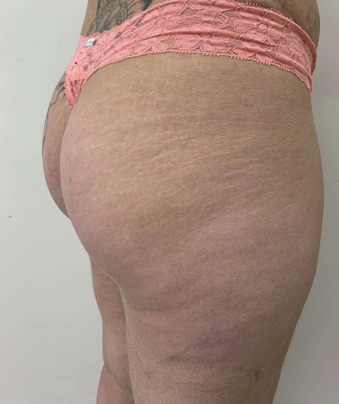 Antes - Harmonização Glútea