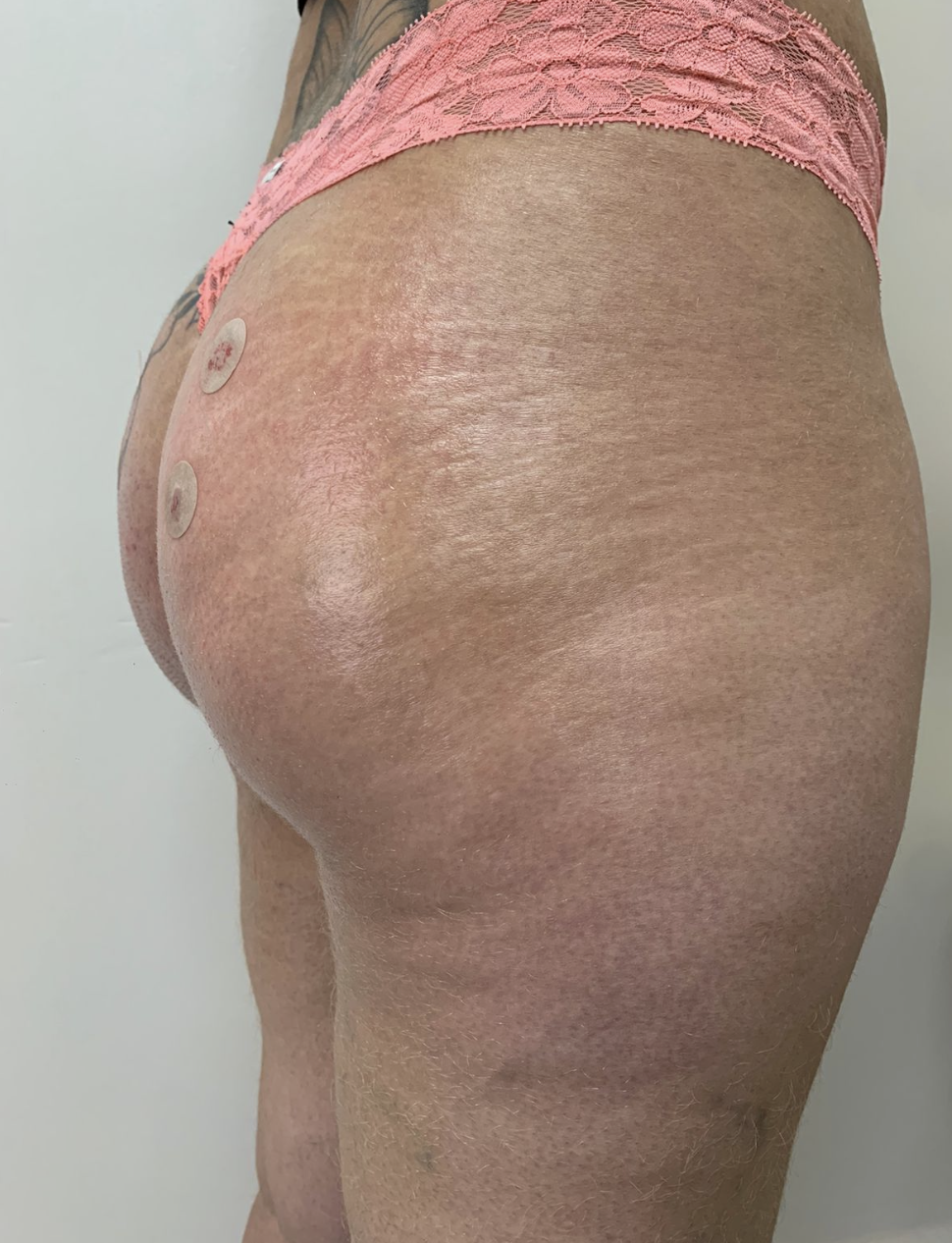 Depois - Harmonização Glútea