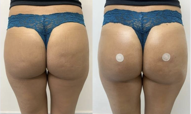 Harmonização Glútea