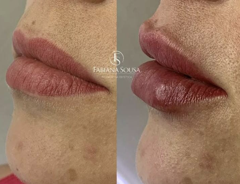 Preenchimento Labial